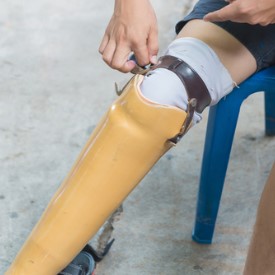 prosthetic leg syndrome