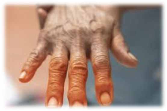 icd 10 cm code for chemotherapy induced neuropathy